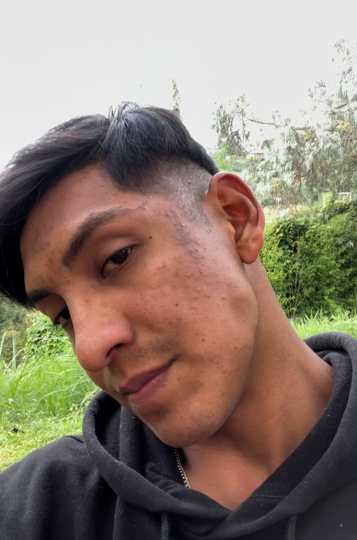 Rostro con ojeras e hinchazón antes de usar la mascarilla de gel frío