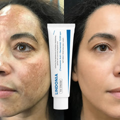 Lindonia® Corrector de Manchas